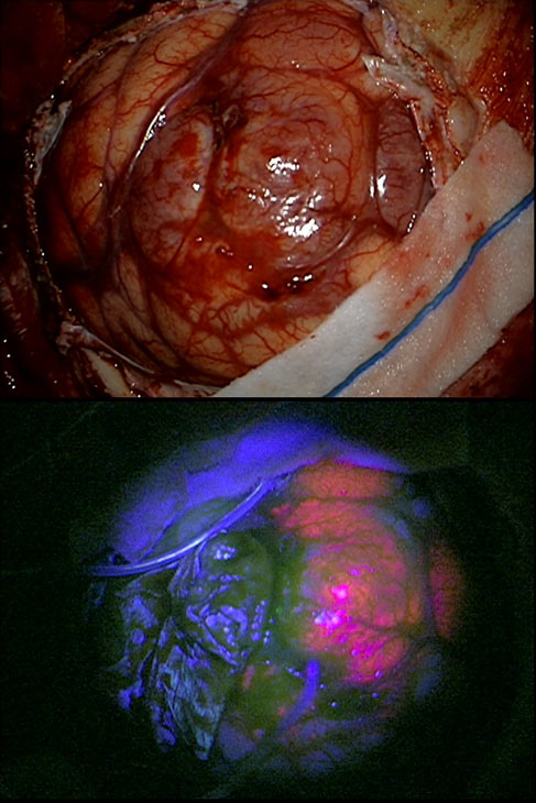 ניתוח להסרת גידול מוח