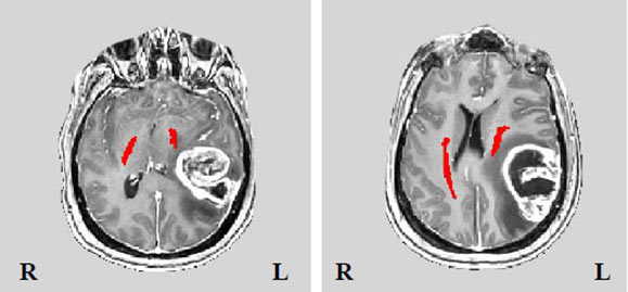 ניתוח להסרת גידול מוח