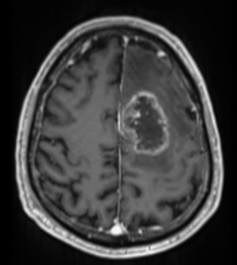 גידולי מוח - גליומה