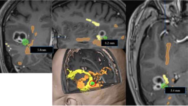 גירוי חשמלי מוחי